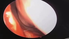 Bác sĩ Việt Nam Gỡ Giun Ký Sinh Sống Động Từ Mũi Người Đàn Ông – Cảnh Kinh Hoàng Khi Giun Bò Lên Đầu!